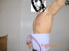 Belt Lipectomy Body Lift Surgery After One Day