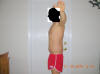 Belt Lipectomy Body Lift Surgery After One Month