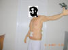 Belt Lipectomy Body Lift Surgery After One Week