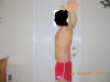 Belt Lipectomy Body Lift Surgery After Two Months