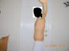 Belt Lipectomy Body Lift Surgery After Two Weeks