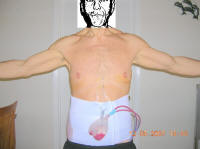 Body Lift Surgery After One Day