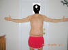Body Lift Surgery After One Month