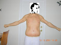 Body Lift Surgery After One Week