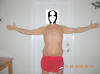 Body Lift Surgery After One Year