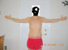 Body Lift Surgery After Two Months