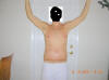 Body Lift Surgery After Two Weeks