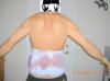 Lower Body Lift Surgery After One Day
