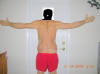 Lower Body Lift Surgery After One Month