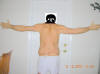 Lower Body Lift Surgery After One Week
