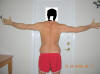 Lower Body Lift Surgery After One Year