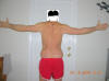 Lower Body Lift Surgery After Three Months