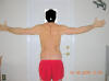 Lower Body Lift Surgery After Two Months