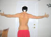 Lower Body Lift Surgery Before Picture