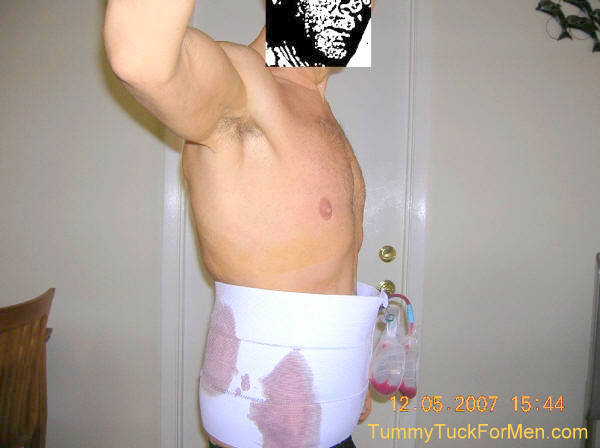 Male Tummy Tuck; Male Abdominoplasty