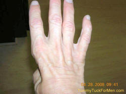 Losing Strength In Fingers And Hand