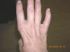 Muscle Atrophy from Ulnar Nerve Damage - images/muscle-atrophy-in-right-hand-caused-by-damage-to-the-ulnar-nerve-weak-fingers_small.JPG