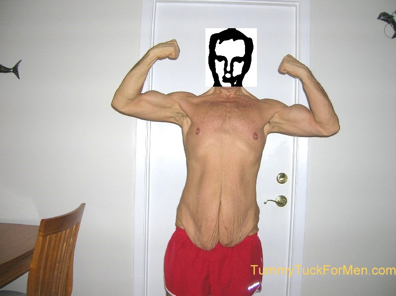 Skin Tuck Before Picture; Skin Tuck - Tummy Tuck Loose Skin
