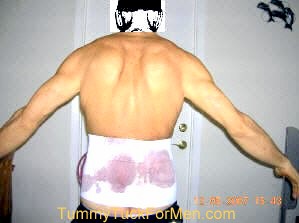 One Day After Tummy Tuck (Abdominoplasty) Plastic Surgery showing back view with compression garment and surgical drains. tummytuckformen.com