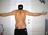 Tummy Tuck Before And After Pictures - Tummy Tuck for Men; Abdominoplasty Plastic Surgery After 2 days showing wound and sutures - back side. tummytuckformen.com