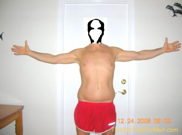 This photograph was taken one year after my tummy tuck with lateral thigh lift operation. My scars are still quite noticeable but are still fading slowly. I was lucky. I had no pain at all throughout my entire experience. tummytuckformen.com