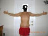 Abdominoplasty Plastic Surgery After 2 months showing front side. tummytuckformen.com