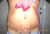 Tummy Tuck Before And After Pictures - Tummy Tuck for Men; Day After Abdominoplasty Plastic Surgery showing surgical drain system. tummytuckformen.com