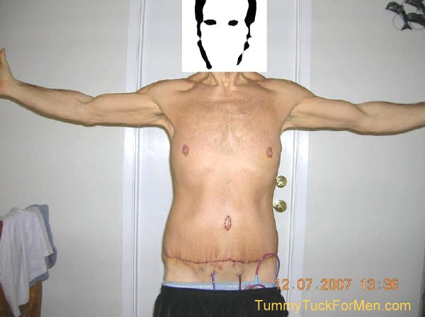 This is a photograph of how I looked from the front 2 days after undergoing Tummy Tuck (Abdominoplasty) Plastic Surgery with Lateral Thigh Lift to remove excess hanging skin from my midsection (having lost over 100 lbs). 