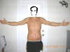 Tummy Tuck Before And After Pictures - Tummy Tuck for Men; Abdominoplasty Plastic Surgery After 2 days showing front side- front view. tummytuckformen.com