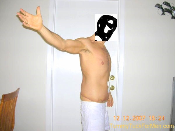 Zoomable "After" photograph of Tummy Tuck (Abdominoplasty) & Lateral Thigh Lift Surgery to remove sagging skin after a 150 pound weight loss. Tummy Tuck before and after picture gallery. Note the scars and swelling one week after surgery.tummytuckformen.com