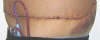 Abdominoplasty Plastic Surgery Scars, Stitches and Swelling after 3 days showing left side. tummytuckformen.com