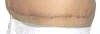 Tummy Tuck Scar Photos, Tummy Tuck Pictures; Abdominoplasty Pictures, Thigh Lift Pictures - Abdominoplasty Plastic Surgery Scars, Stitches and Swelling after 2 weeks showing left side. tummytuckformen.com