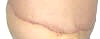 Abdominoplasty Plastic Surgery Scars, Stitches and Swelling after 3 days showing right side. tummytuckformen.com