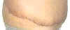 Abdominoplasty Plastic Surgery Scars, Stitches and Swelling after 2 weeks showing right side. tummytuckformen.com