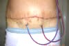 Tummy Tuck Before And After Pictures - Tummy Tuck for Men; Day After Abdominoplasty Plastic Surgery showing surgical drain tubing body locations. tummytuckformen.com