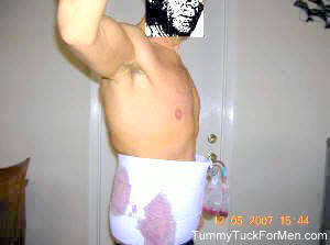 Tummy Tuck for Men; One Day After Tummy Tuck