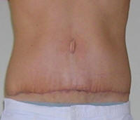 Tummy Tuck Pictures; Abdominoplasty Pictures, Thigh Lift Pictures - Tummy Tuck Before And After Pictures - After 18 Days