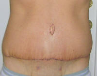 Tummy Tuck Healing After 12 Days