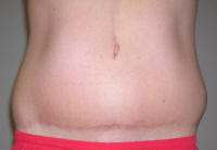 Tummy Tuck Healing After 19 Days
