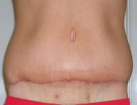 Tummy Tuck Healing After 1 Month