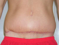 Tummy Tuck Healing After 1 Month And 2 Weeks