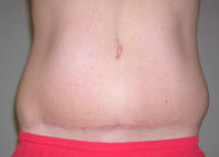 Tummy Tuck Healing After 1 Year
