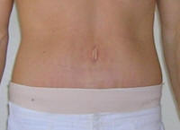 Tummy Tuck Healing After 23 Days