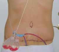 Tummy Tuck Healing After 4 Days