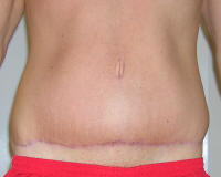 Tummy Tuck Healing After 5 Months