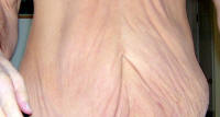 Tummy Tuck Healing Before Picture