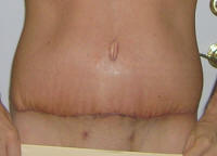 Tummy Tuck Scars After 17 Days