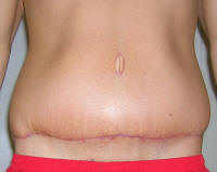 Tummy Tuck Scars After 1 Month And 1 Week