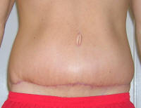Tummy Tuck Scars After 1 Month And 3 Weeks
