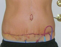Tummy Tuck Scar Photos,